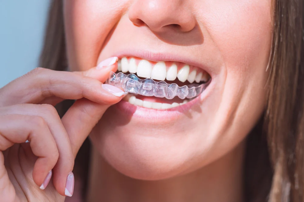 How Long Does Clear Aligner Treatment Take